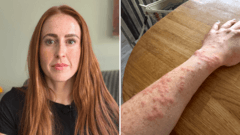 Woman attacked by bed bugs during Travelodge stay